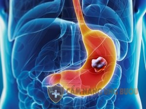 ung thu da day chua duoc khong