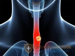 Ung thư thực quản giai đoạn cuối