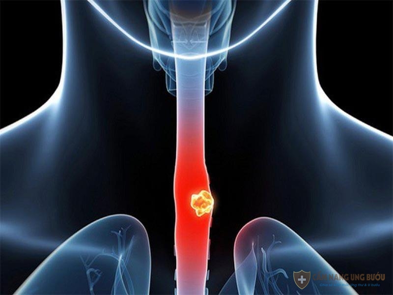 Ung thư thực quản giai đoạn cuối