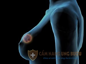 Nguyên nhân gây nên bệnh ung thư vú