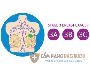 Ung thư vú giai đoạn 3