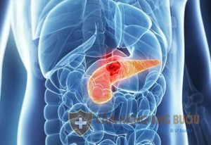 Bệnh nhân ung thư tuyến tụy cần có chế độ dinh dưỡng khoa học và phù hợp