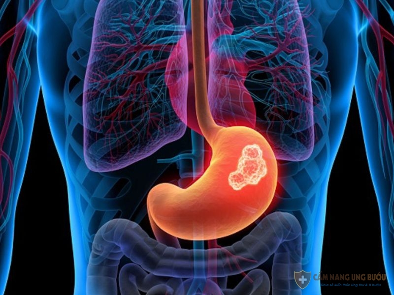 Ung thư dạ dày giai đoạn đầu