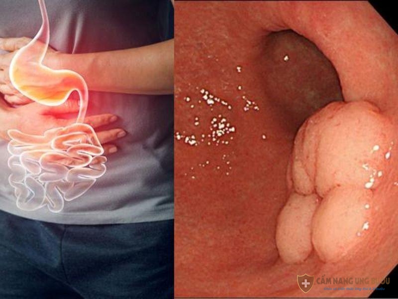 Căn bệnh ung thư dạ dày rất nguy hiểm