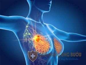 Căn bệnh ung thư vú rất nguy hiểm