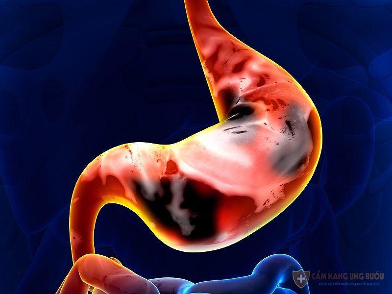 Tỷ lệ sống sau5 năm ung thư