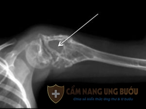 Các xét nghiệm ung thư xương