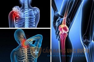 Dấu hiệu của căn bệnh ung thư xương di căn
