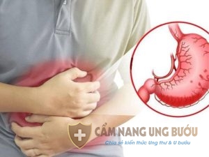 Căn bệnh ung thư dạ dày giai đoạn 2