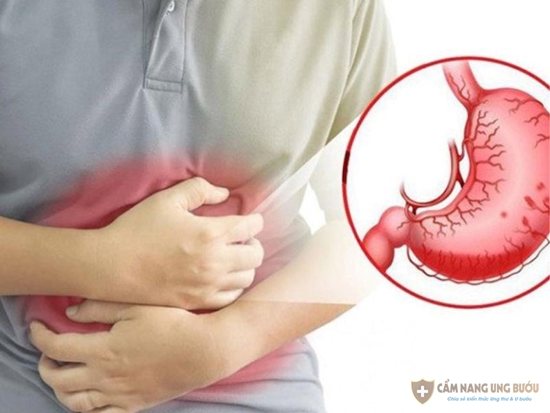 Căn bệnh ung thư dạ dày giai đoạn 2