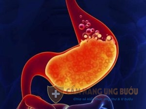 Căn bệnh ung thư dạ dày rất nguy hiểm
