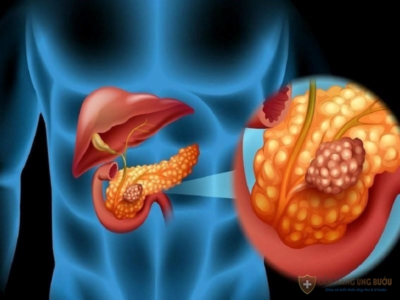 Căn bệnh ung thư tuyến tụy khá ít gặp nhưng rất nguy hiểm