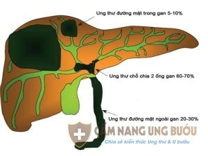 Nguyên nhân gây nên căn bệnh ung thư đường mật