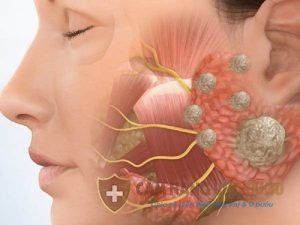 Ung thư tuyến nước bọt