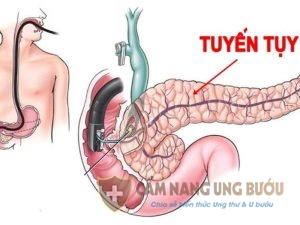 Ung thư tuyến tụy di căn gan thường ở giai đoạn cuối của bệnh