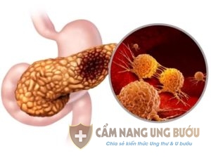 Ung thư tuyến tụy giai đoạn 3