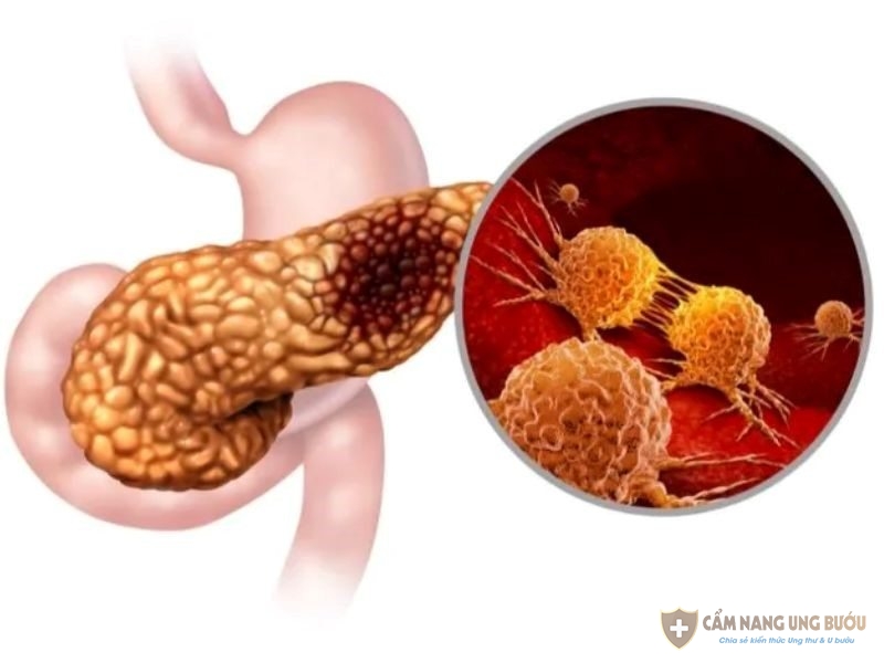 Ung thư tuyến tụy giai đoạn 3