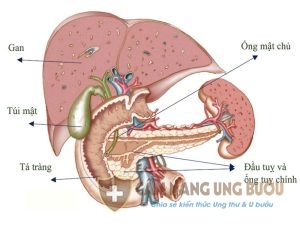 Ung thư tuyến tụy giai đoạn 4 rất nguy hiểm
