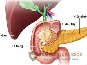 Căn bệnh ung thư tuyến tụy