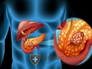 Căn bệnh ung thư tuyến tụy khá ít gặp nhưng rất nguy hiểm