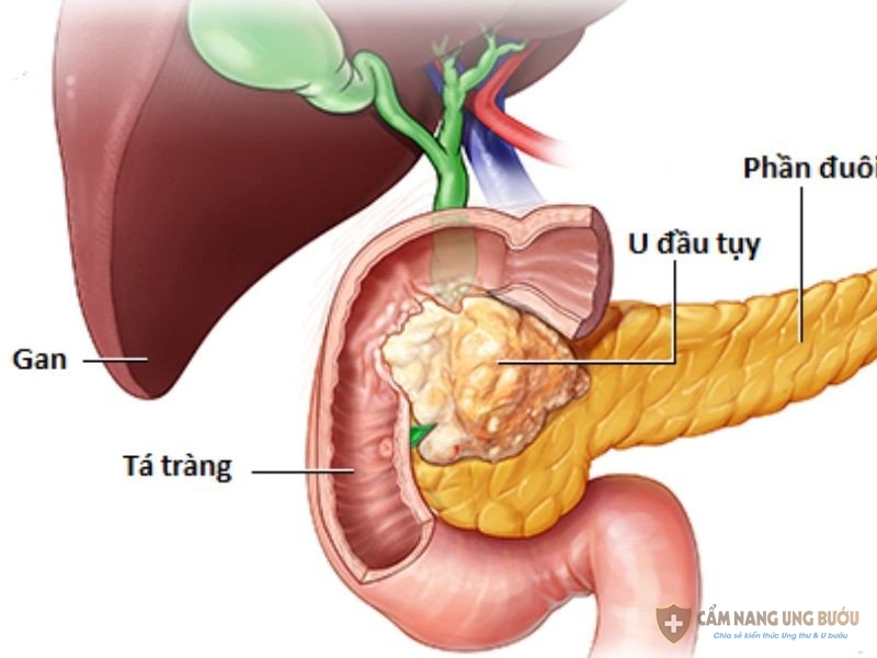 Căn bệnh ung thư tuyến tụy